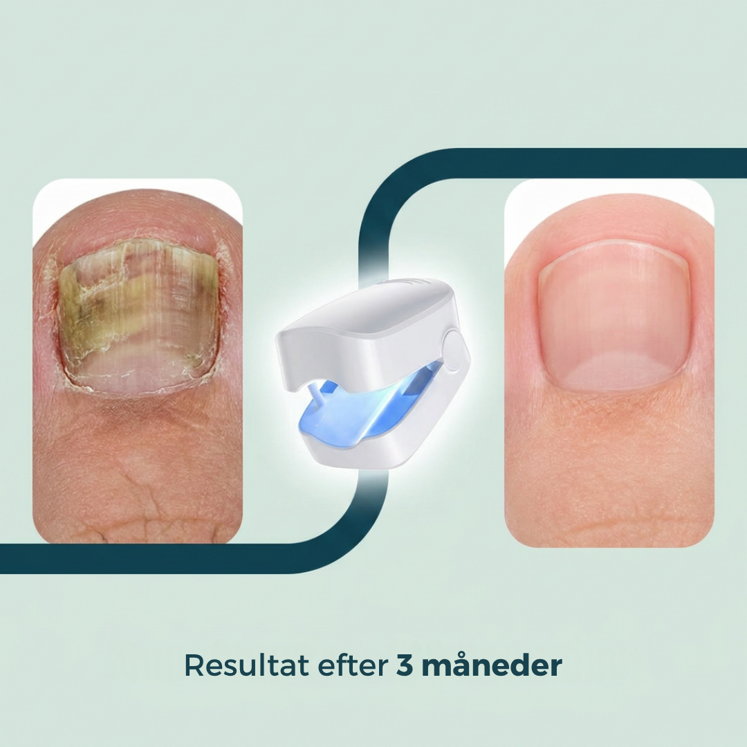 ClearNegl™ - Sig farvel til misfarvede og usunde negle for altid!