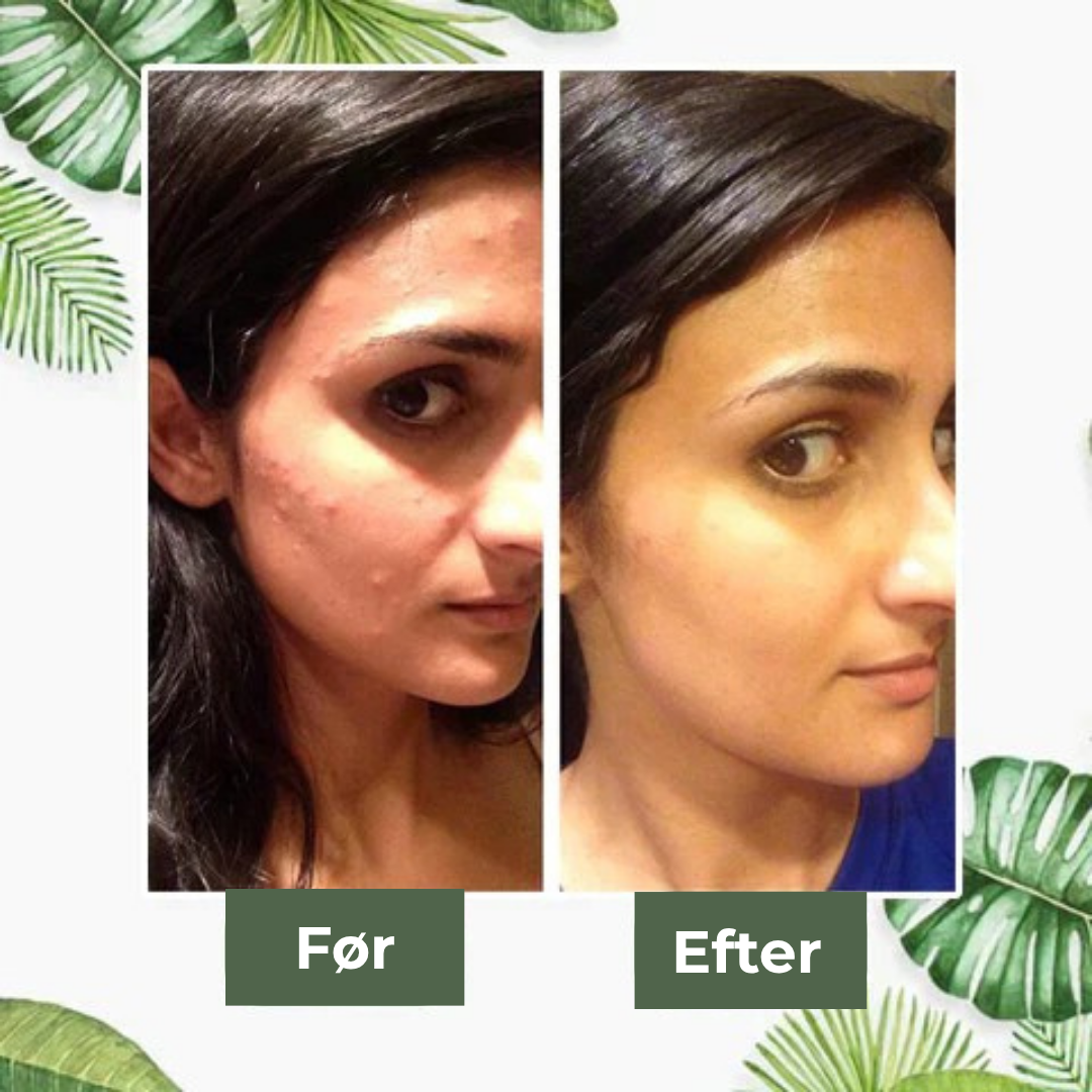 GreenTea Maske™ - Sig farvel til acne og hudorme!
