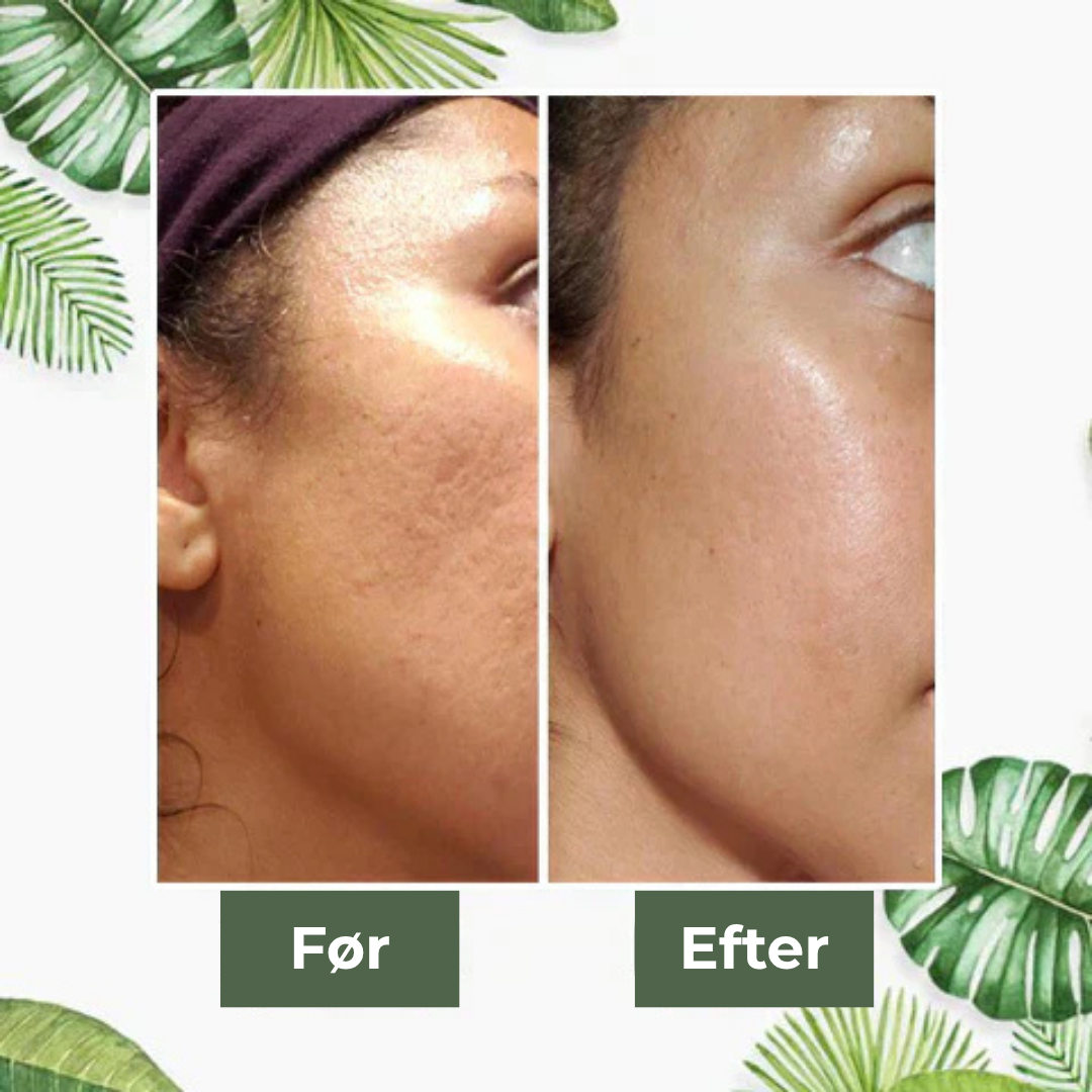 GreenTea Maske™ - Sig farvel til acne og hudorme!