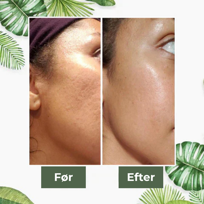 GreenTea Maske™ - Sig farvel til acne og hudorme!